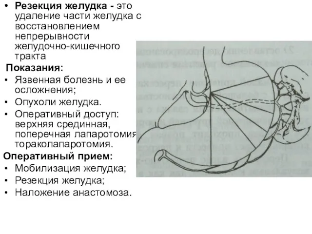 Резекция желудка - это удаление части желудка с восстановлением непрерывности