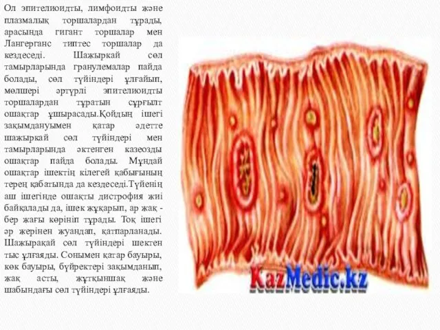 Ол эпителиоидты, лимфоидты және плазмалық торшалардан тұрады, арасында гигант торшалар