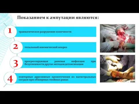 Показанием к ампутации являются: 1 2 3 4