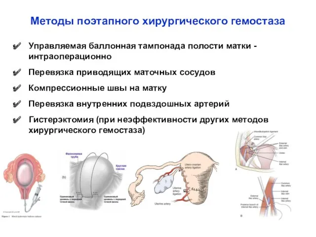 Методы поэтапного хирургического гемостаза Управляемая баллонная тампонада полости матки -