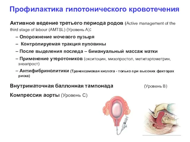 Профилактика гипотонического кровотечения Активное ведение третьего периода родов (Active management