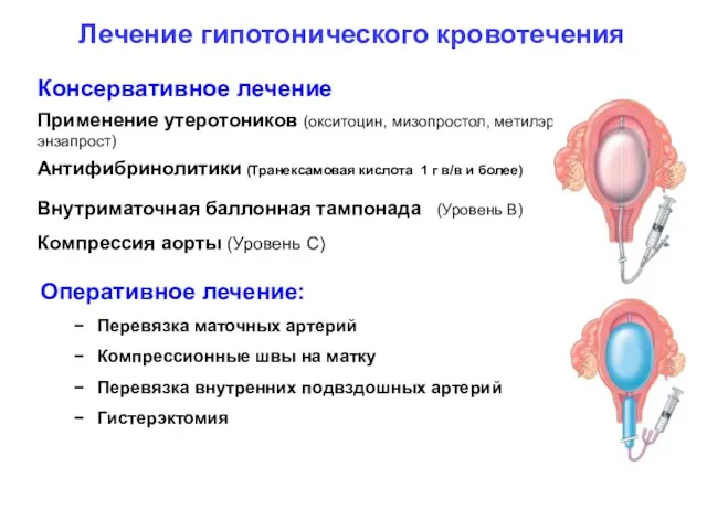 Лечение гипотонического кровотечения Консервативное лечение Применение утеротоников (окситоцин, мизопростол, метилэргометрин,