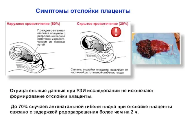 Симптомы отслойки плаценты Отрицательные данные при УЗИ исследовании не исключают