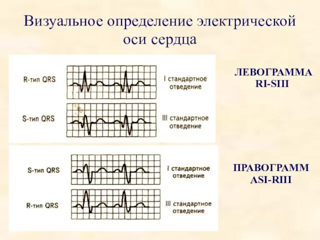 Визуальное определение электрической оси сердца ПРАВОГРАММАSI-RIII ЛЕВОГРАММА RI-SIII