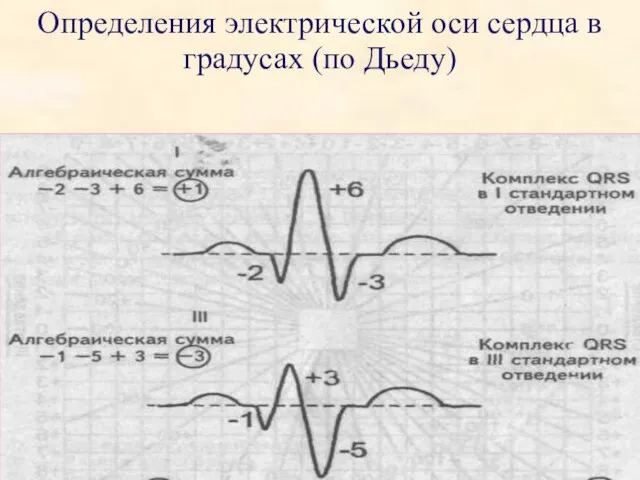 Определения электрической оси сердца в градусах (по Дьеду)
