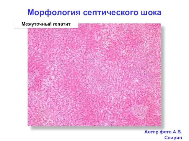 Морфология септического шока Межуточный гепатит Автор фото А.В. Спирин