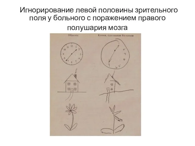 Игнорирование левой половины зрительного поля у больного с поражением правого полушария мозга