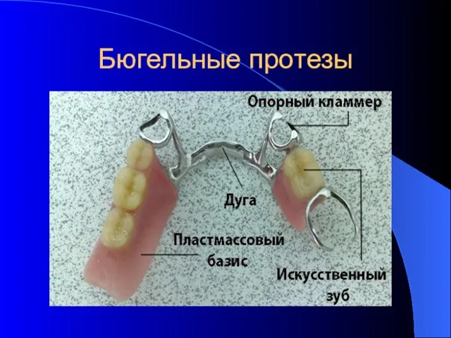 Бюгельные протезы