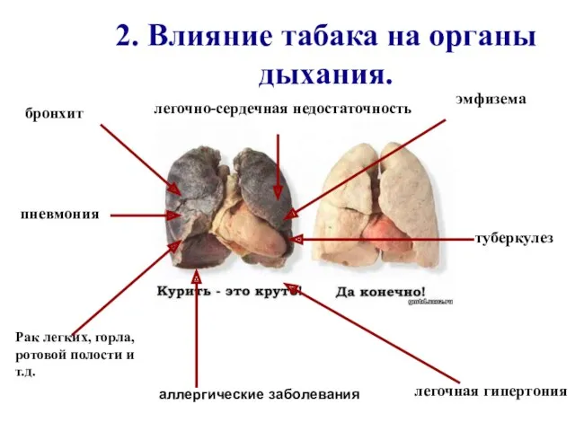 2. Влияние табака на органы дыхания. пневмония бронхит Рак легких,