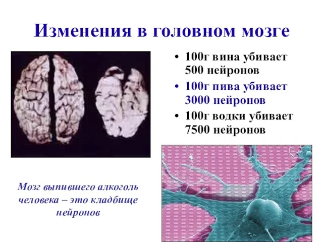 Изменения в головном мозге 100г вина убивает 500 нейронов 100г