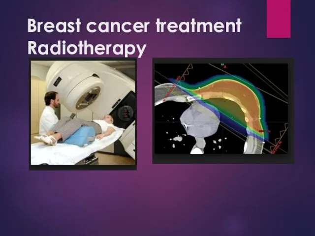 Breast cancer treatment Radiotherapy