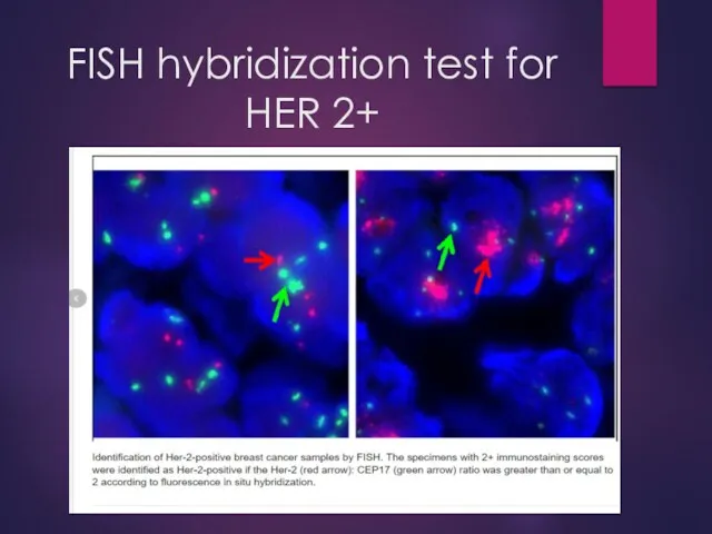 FISH hybridization test for HER 2+