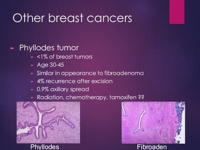 Other breast cancers Phyllodes tumor Age 30-45 Similar in appearance