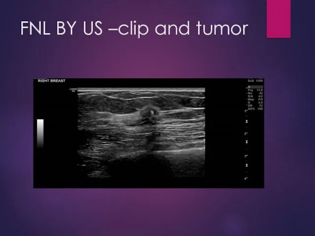 FNL BY US –clip and tumor