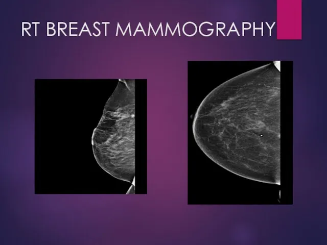 RT BREAST MAMMOGRAPHY