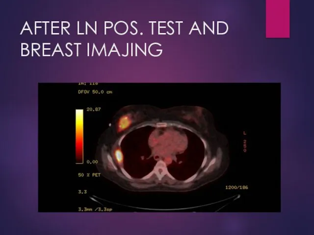 AFTER LN POS. TEST AND BREAST IMAJING