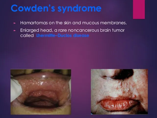Cowden’s syndrome Hamartomas on the skin and mucous membranes. Enlarged