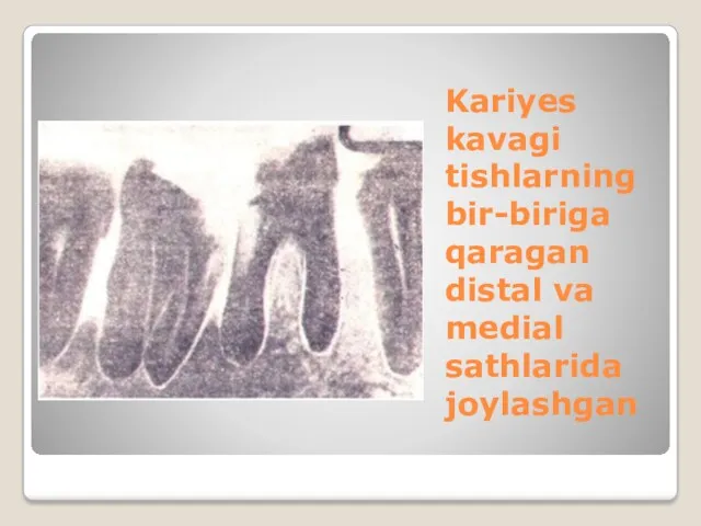 Kariyes kavagi tishlarning bir-biriga qaragan distal va medial sathlarida joylashgan