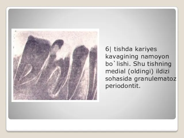6| tishda kariyes kavagining namoyon bo`lishi. Shu tishning medial (oldingi) ildizi sohasida granulematoz periodontit.