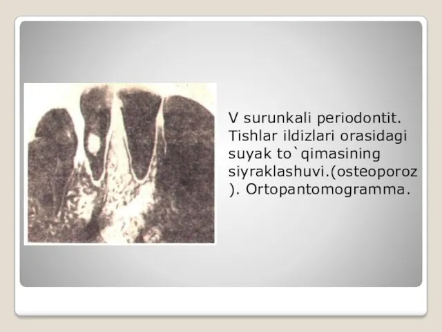 V surunkali periodontit. Tishlar ildizlari orasidagi suyak to`qimasining siyraklashuvi.(osteoporoz). Ortopantomogramma.