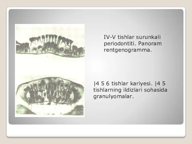 IV-V tishlar surunkali periodontiti. Panoram rentgenogramma. |4 5 6 tishlar