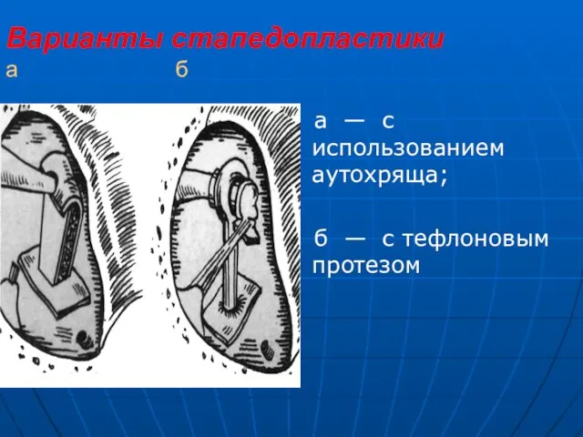 Варианты стапедопластики а б а — с использованием аутохряща; б — с тефлоновым протезом