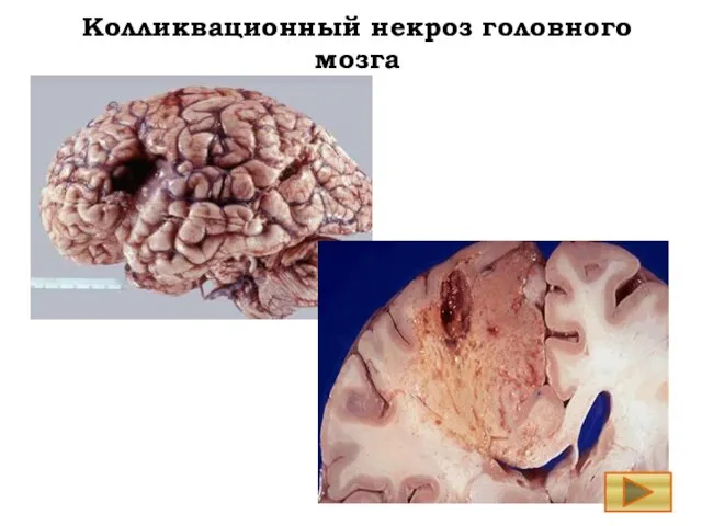 Колликвационный некроз головного мозга