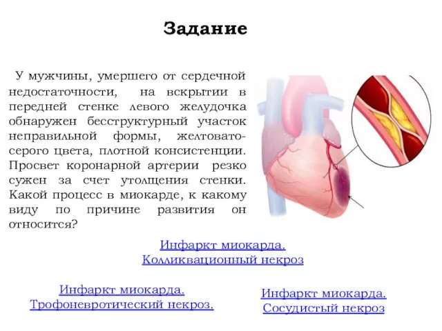 Задание У мужчины, умершего от сердечной недостаточности, на вскрытии в