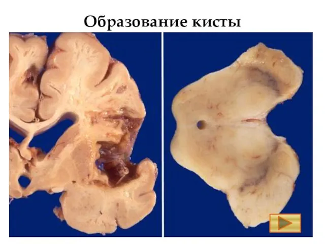 Образование кисты