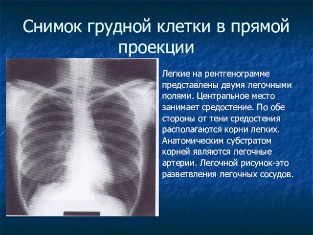 Снимок грудной клетки в прямой проекции Легкие на рентгенограмме представлены