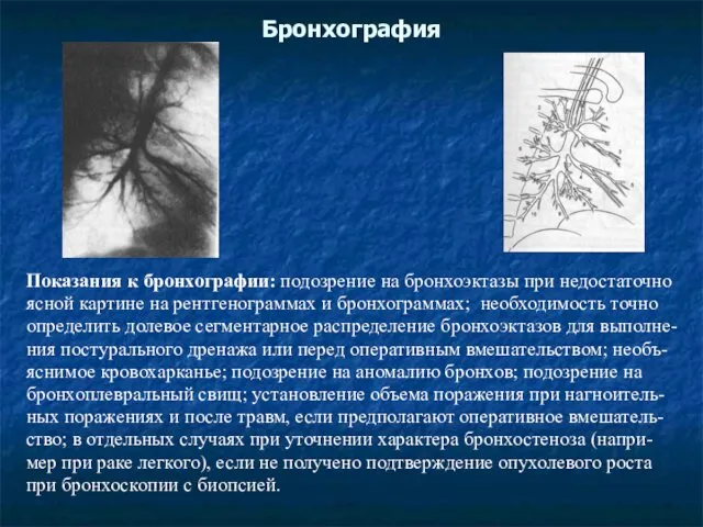 Бронхография Показания к бронхографии: подозрение на бронхоэктазы при недостаточно ясной