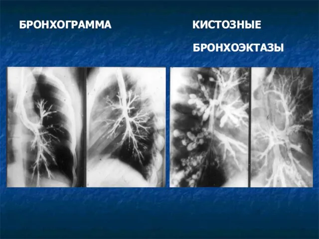 БРОНХОГРАММА КИСТОЗНЫЕ БРОНХОЭКТАЗЫ