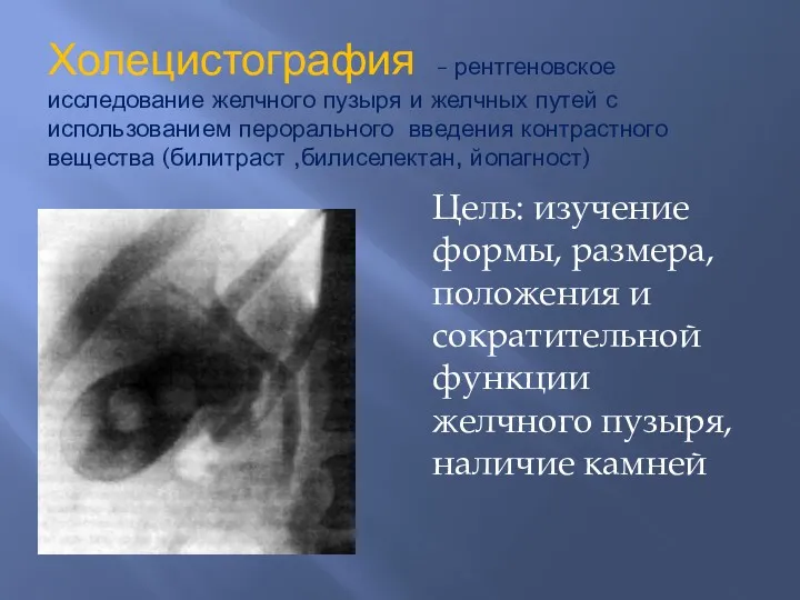 Холецистография – рентгеновское исследование желчного пузыря и желчных путей с