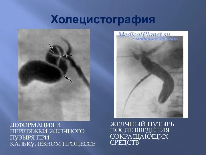 Холецистография ДЕФОРМАЦИЯ И ПЕРЕТЯЖКИ ЖЕЛЧНОГО ПУЗЫРЯ ПРИ КАЛЬКУЛЕЗНОМ ПРОЦЕССЕ ЖЕЛЧНЫЙ ПУЗЫРЬ ПОСЛЕ ВВЕДЕНИЯ СОКРАЩАЮЩИХ СРЕДСТВ