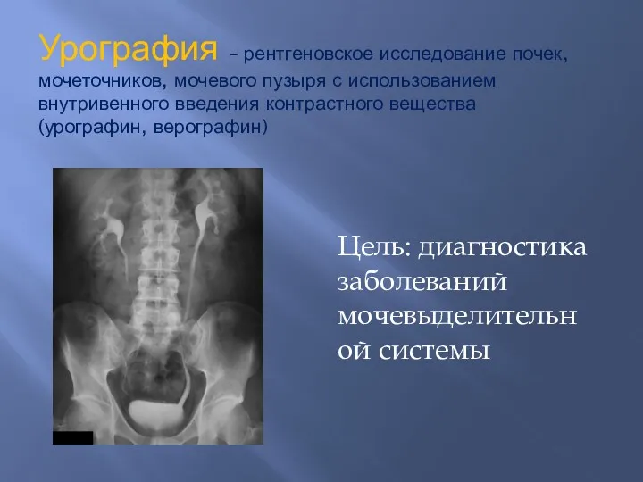 Урография – рентгеновское исследование почек, мочеточников, мочевого пузыря с использованием