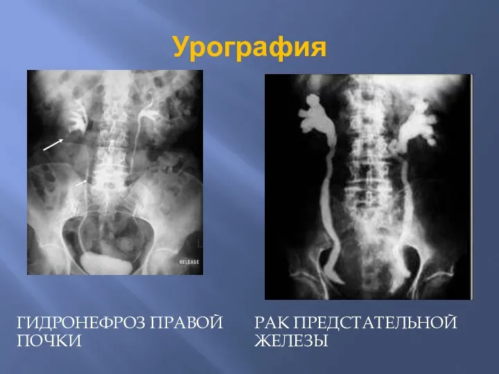 Урография ГИДРОНЕФРОЗ ПРАВОЙ ПОЧКИ РАК ПРЕДСТАТЕЛЬНОЙ ЖЕЛЕЗЫ