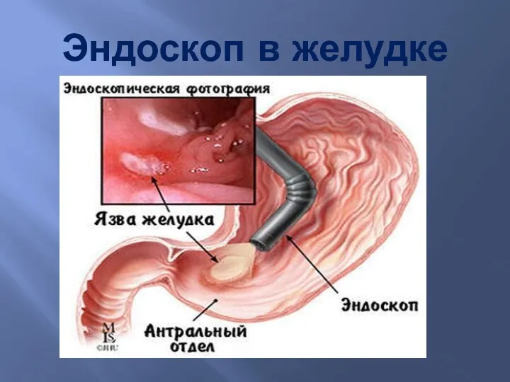 Эндоскоп в желудке