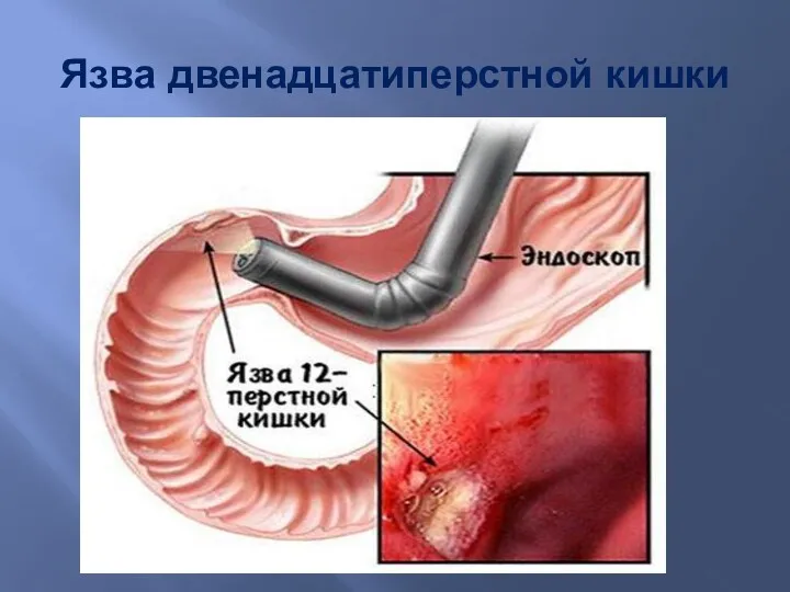 Язва двенадцатиперстной кишки