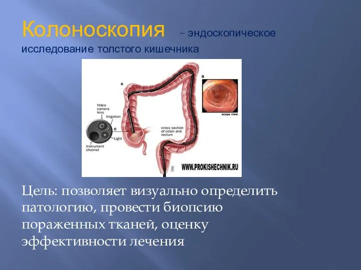 Колоноскопия – эндоскопическое исследование толстого кишечника Цель: позволяет визуально определить