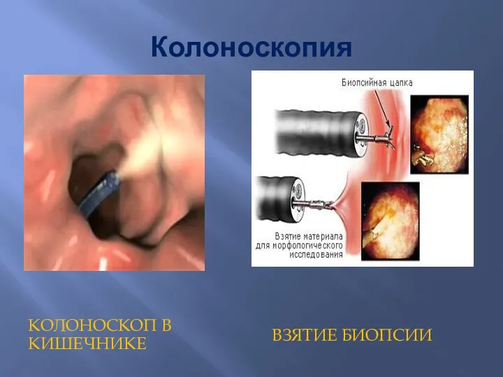 Колоноскопия КОЛОНОСКОП В КИШЕЧНИКЕ ВЗЯТИЕ БИОПСИИ