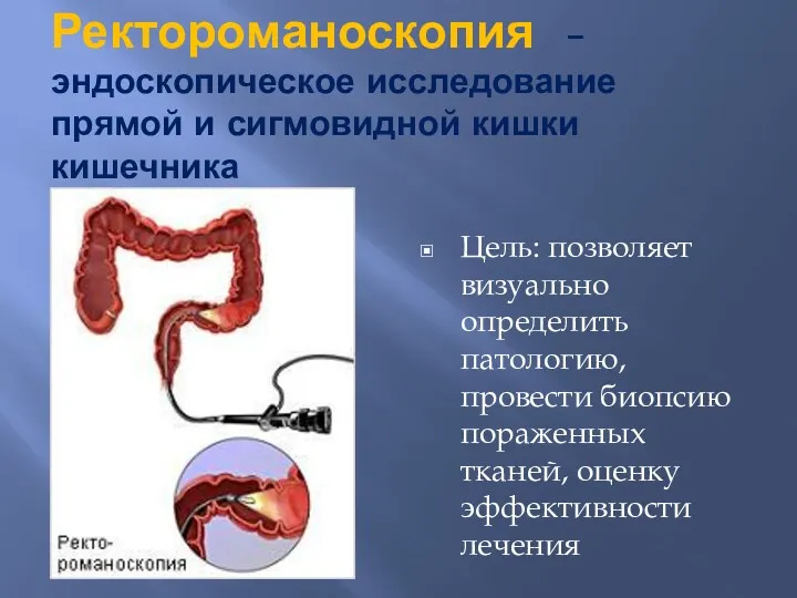 Ректороманоскопия – эндоскопическое исследование прямой и сигмовидной кишки кишечника Цель: