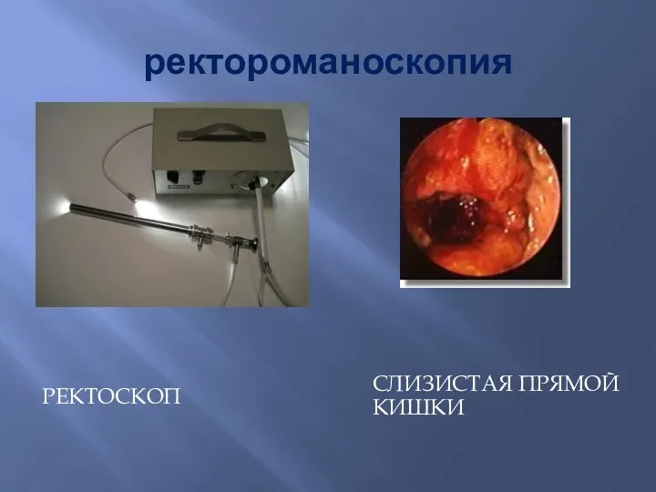 ректороманоскопия РЕКТОСКОП СЛИЗИСТАЯ ПРЯМОЙ КИШКИ