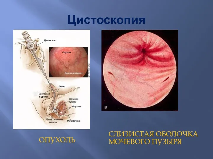 Цистоскопия ОПУХОЛЬ СЛИЗИСТАЯ ОБОЛОЧКА МОЧЕВОГО ПУЗЫРЯ