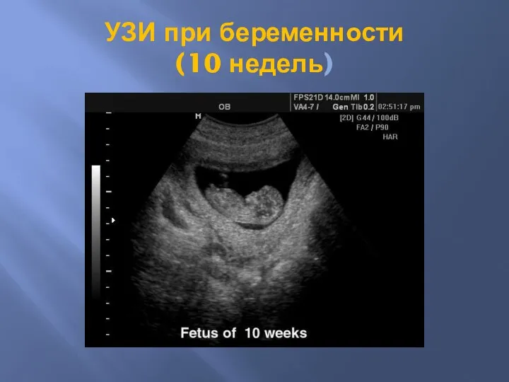 УЗИ при беременности (10 недель)