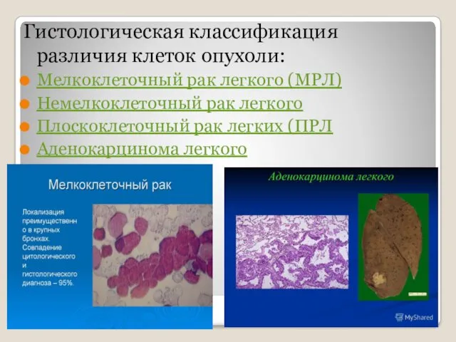 Гистологическая классификация различия клеток опухоли: Мелкоклеточный рак легкого (МРЛ) Немелкоклеточный рак легкого Плоскоклеточный