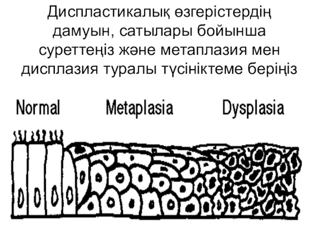 Диспластикалық өзгерістердің дамуын, сатылары бойынша суреттеңіз және метаплазия мен дисплазия туралы түсініктеме беріңіз