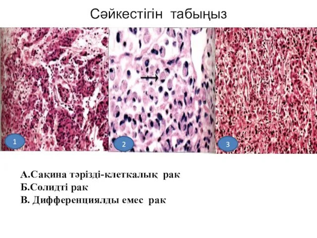 Сәйкестігін табыңыз А.Сақина тәрізді-клеткалық рак Б.Солидті рак В. Дифференциялды емес рак 1 3 2
