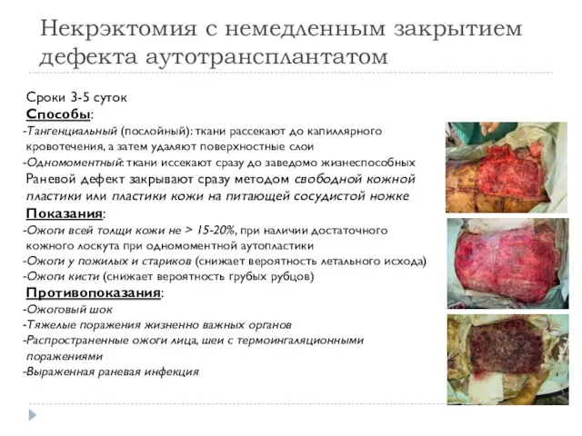 Некрэктомия с немедленным закрытием дефекта аутотрансплантатом Сроки 3-5 суток Способы: