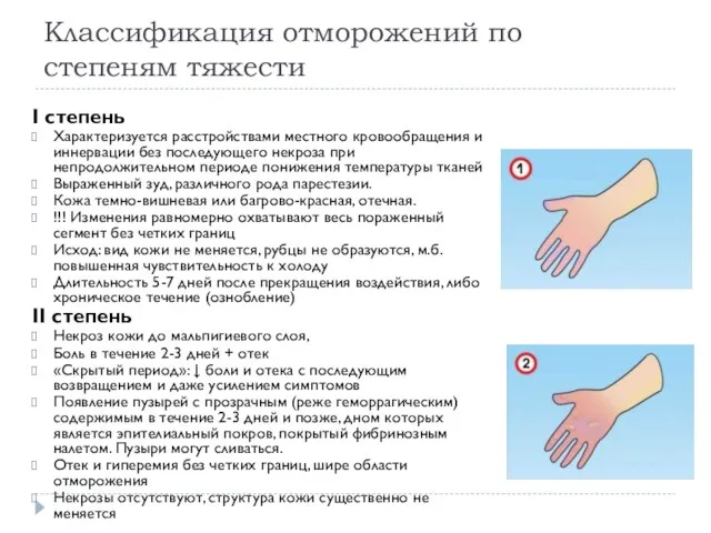 Классификация отморожений по степеням тяжести I степень Характеризуется расстройствами местного