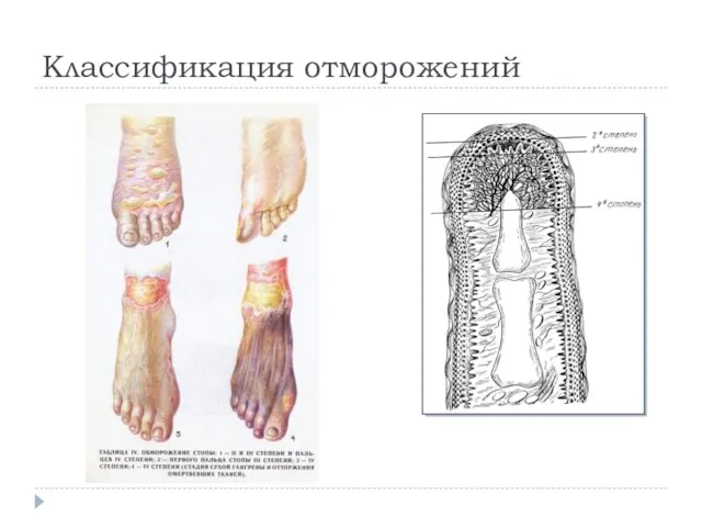 Классификация отморожений